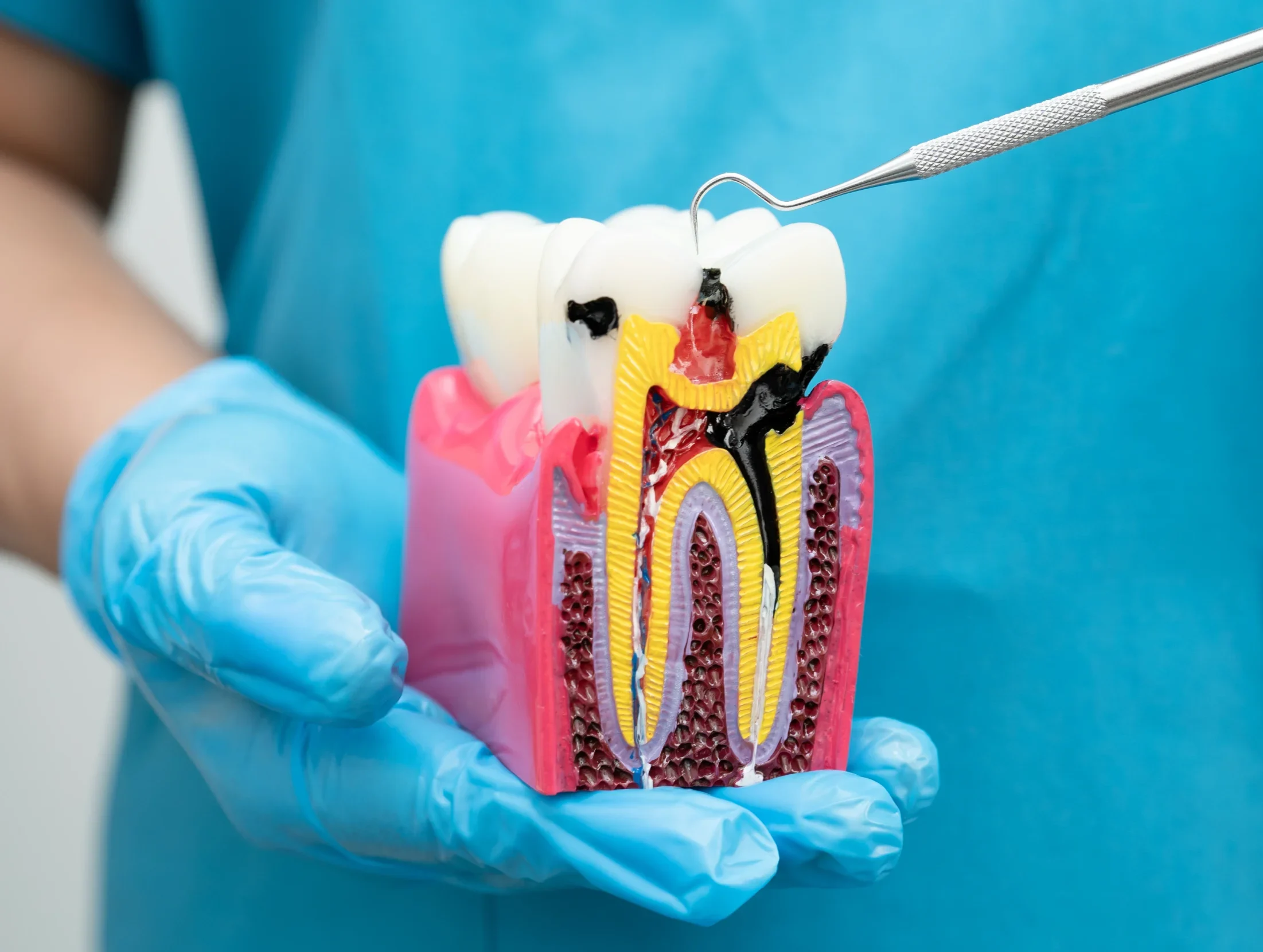 A dentist showcases and guiding a model of a tooth, affected by root canal