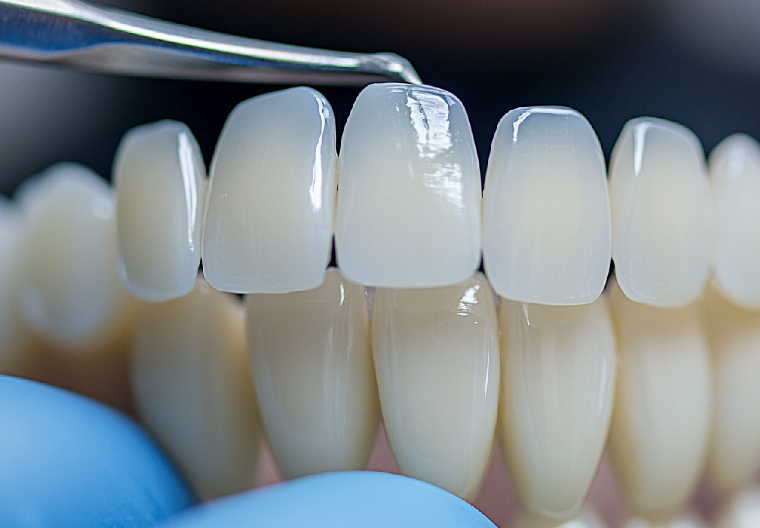 A doctor working on dental veneers in Paradise, NV