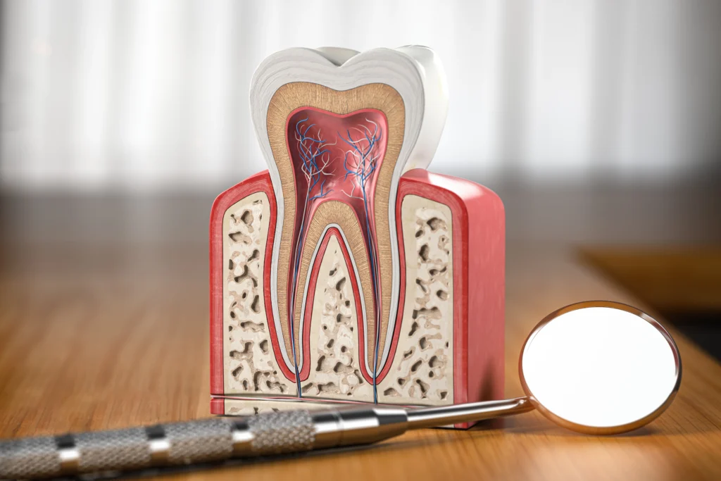 A tooth model affected by a root canal