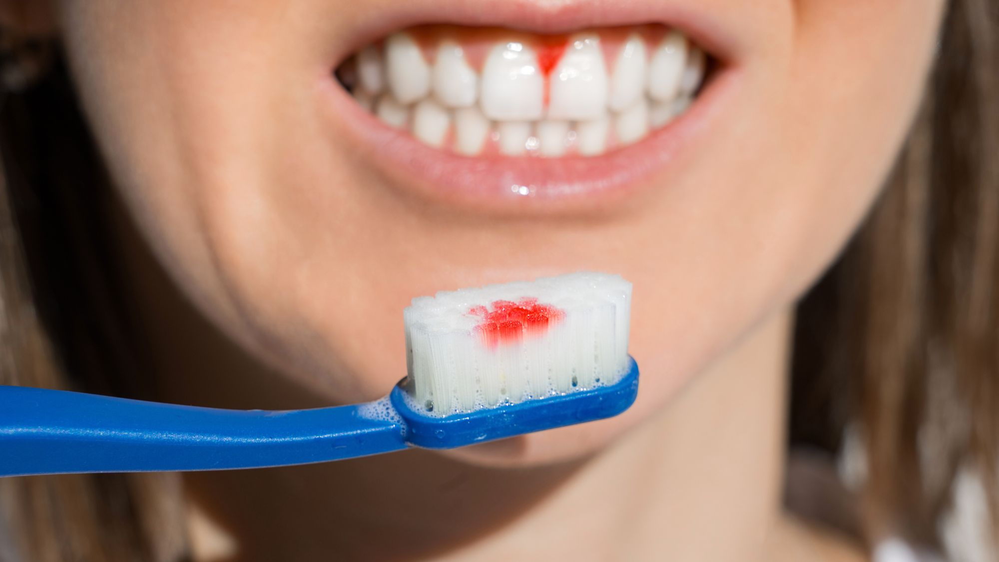 A woman showing gum bleeding while brushing, with blood on the toothbrush