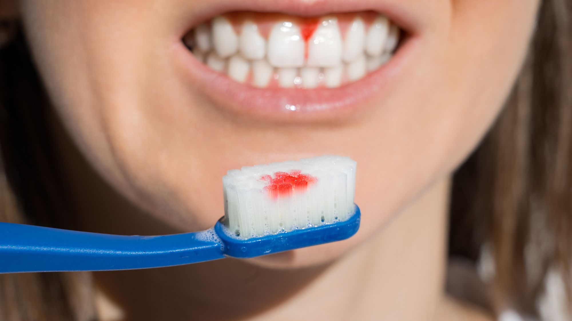 A young woman showing her bleeding gums and bloody toothbrush